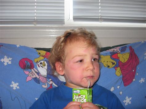 Babies Kunes Amoxicillin Allergy