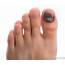 What Are The Common Cause Of Pus In A Toe With Pictures