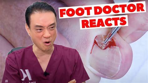 Foot Doctor Reacts To People Removing Their Own Ingrown Toenails Dr Kim Holistic Foot Doctor