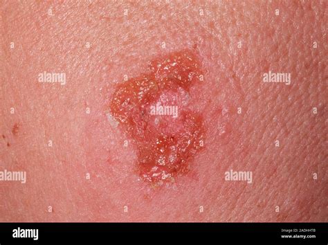 Impetigo Infection On The Cheek Of A 45 Year Old Woman Impetigo Is A