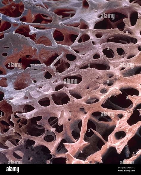 Spongy Bone Coloured Scanning Electron Micrograph Sem Of Human