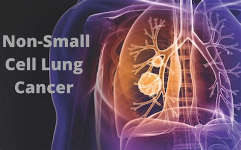 What Is Non Small Cell Lung Cancer What Are The Stages Of Nsclc