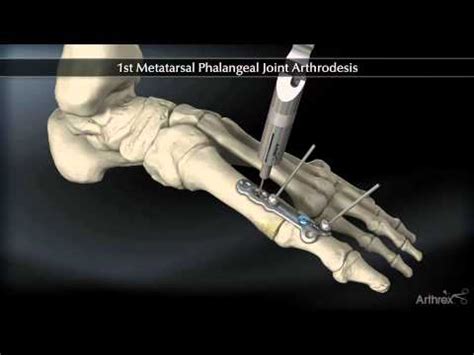 St Metatarsal Phalangeal Joint Arthrodesis Youtube