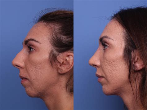 Chin Implant Before And After Pictures Case 375 Scottsdale Az
