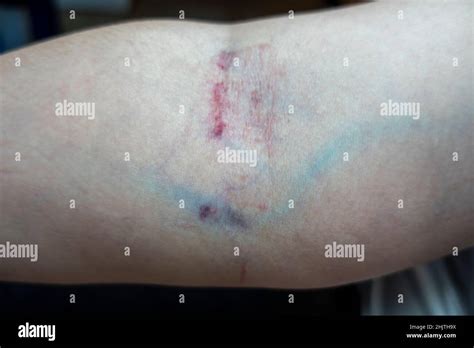 Woman Bruising Arm Hi Res Stock Photography And Images Alamy