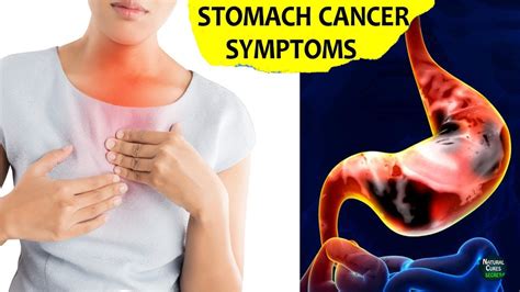 Stomach Cancer Early Sign And Symptoms Gastric Cancer Youtube
