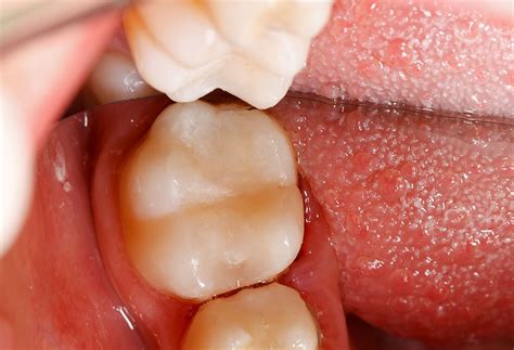 Fillings Tooth Restoration And Restorative Dentistry In Brampton