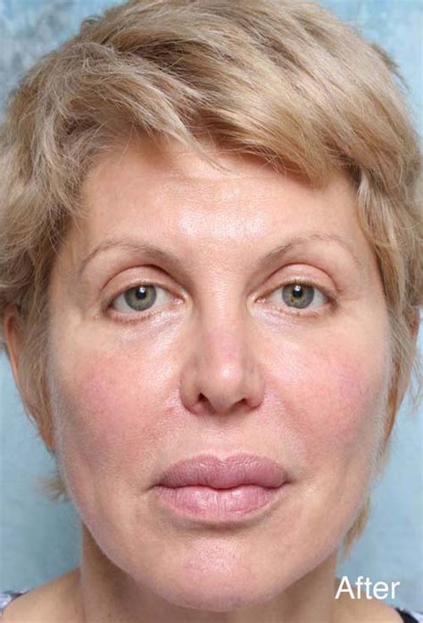 Beverly Hills Botox Before And After Photos Ca Plastic Surgery Photo