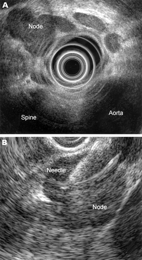 Role Of Endoscopic Ultrasound And Endoscopic Ultrasound Guided Fine