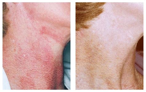 Poikiloderma Of Civatte Neck Pigmentation Dermacare Cosmetic And