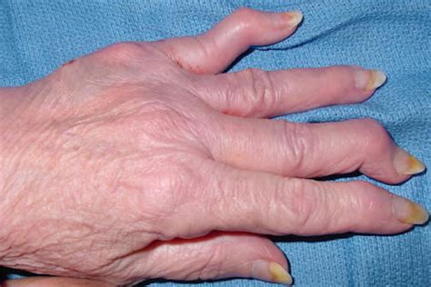 Psoriatic Arthritis Hand Surgery Source