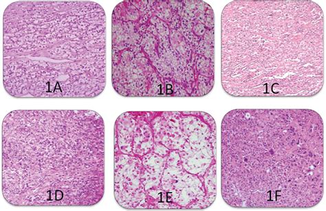 A New Grading for Clear Cell Renal Cell Carcinoma: Combined WHO/ISUP Grading System