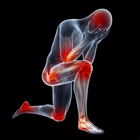 Artrite Reumatóide O Que é E Quais Os Sintomas