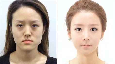 Korean Plastic Surgery Before And After Twins