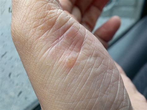 Psoriasis Causes Symptoms Diagnosis And Treatment Skinpractice
