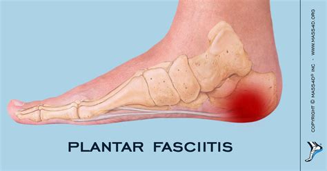 Causes And Symptoms Of Plantar Fasciitis Mass4d® Insoles Mass4d