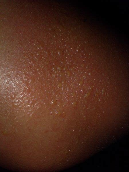 Sunburn Blisters Causes Picture Symptoms And Treatment