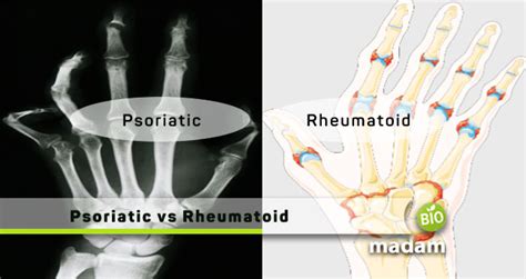 Difference Between Rheumatoid Arthritis And Psoriatic Arthritis Biomadam