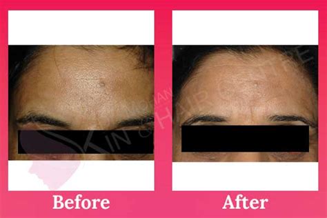 Botox Treatment For Wrinkles India Botox Injection Cost In Phagwara