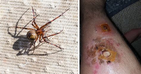Soldier Woke Up To Find False Widow Spider Biting His Leg Metro News