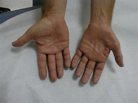 Carpal Tunnel Syndrome Cts Vs Pronator Teres Syndrome Pts Whats