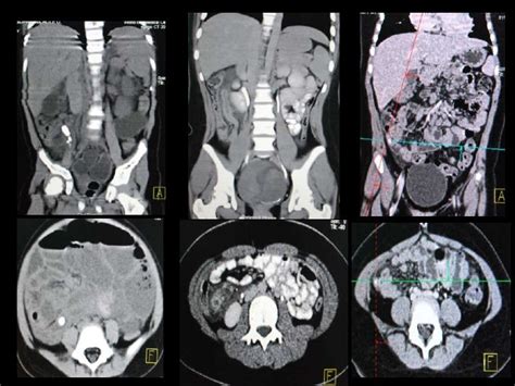 Constipation Ct Scan Ct Scan Machine