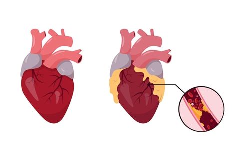 Corazón Humano Sano Y Malsano Enfermedad Isquémica Arteria Coronaria
