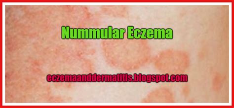 Nummular Eczema Eczema And Dermatitis