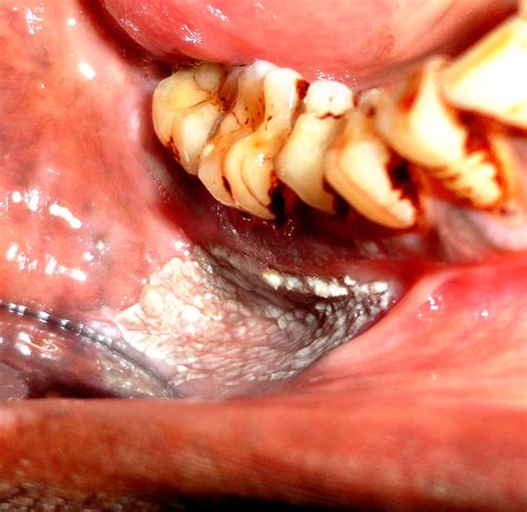 Idiopathic Proliferative Verrucous Leukoplakia Report Of A Clinical