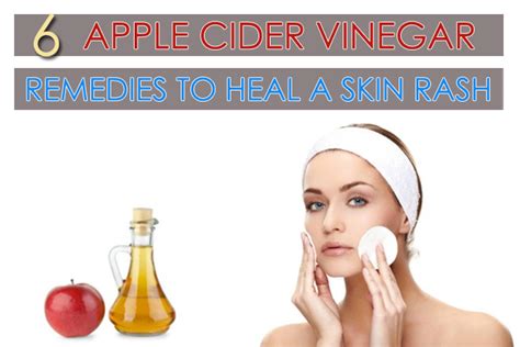 6 Apple Cider Vinegar Remedies To Heal A Skin Rash
