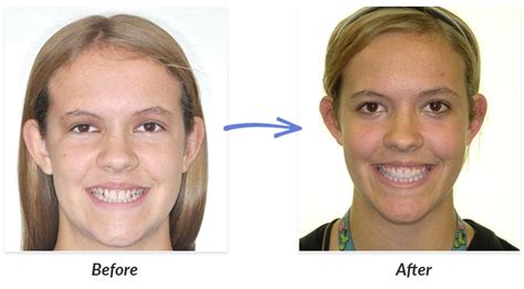 Before After 3 Delurgio Orthodontics Delurgio Orthodontics