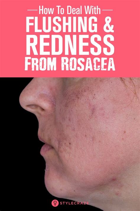 How To Deal With Flushing And Redness From Rosacea Rosacea Redness