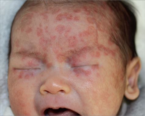 Facial Rash Fever And Anemia In A Newborn Dermatology Jama The Jama Network