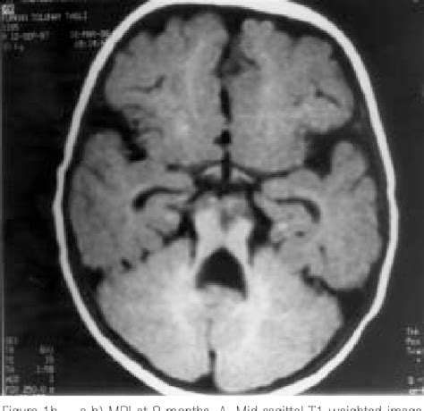 Figure 1 From Mri In Joubert Syndrome Mri In Joubert Syndrome