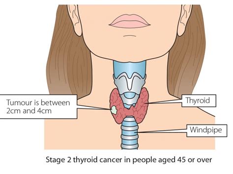 What Are The Grades And Stages Of Thyroid Cancer Irish Cancer Society