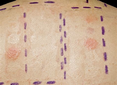 What To Do When You Have Contact Dermatitis Patch Testing