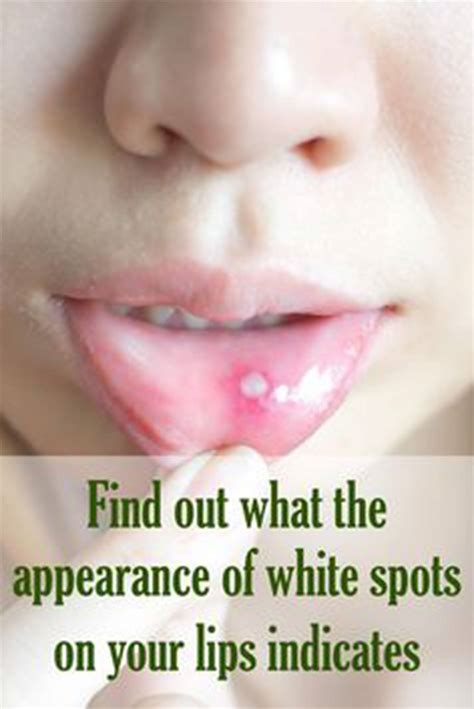 7 Best Tips To Treat White Spots On Lips Healthy Lifestyle