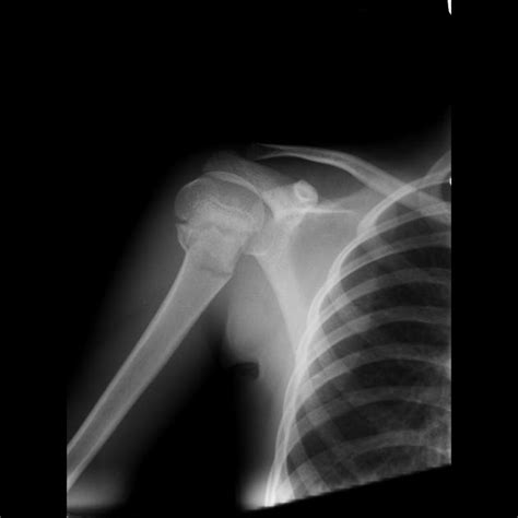 Humeral Surgical Neck Fracture Radiology Case