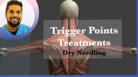 Trigger Point Treatment Dry Needling For Trigger Point Release Youtube