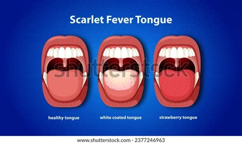 Scarlet Fever Tongue Symptoms Scarlet Fever Stock Illustration