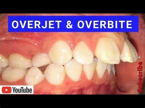 Overjet Overbite Causes Treatment Using Braces Invisalign Youtube