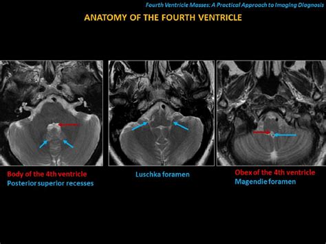 Figure 5 From Fourth Ventricle Masses A Practical Approach To Imaging