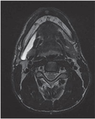 Scielo Brasil Surgical Treatment Of Sublingual Gland Ranulas