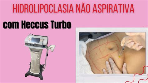 Protocolo Hidrolipoclasia Não Aspirativa Para Gordura Localizada Youtube