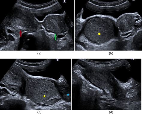 A High Resolution Ultrasound Image Of Pelvis Uterine Didelphy Is