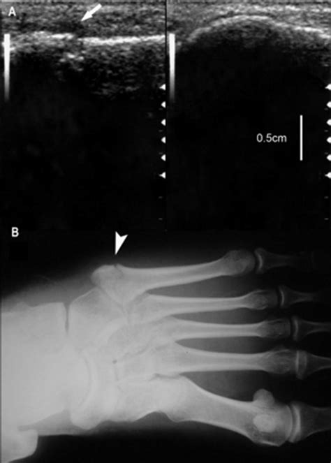 A Sonograms For The Sagittal Section Of The Lateral Fifth Metatarsal Download Scientific