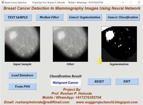 Matlab Code Breast Cancer Detection Using Neural Network Project Source