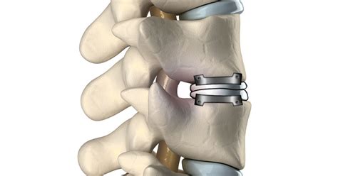 Cervical Artificial Disc Arthroplasty Seattle Wa Brain And Spine Surgery