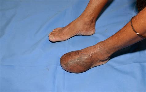Major Crush Injury Fore Foot Degloving Of Forefoot Latissimus Dorsi