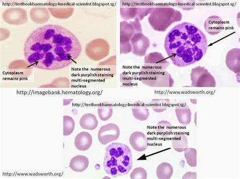 Haematology In A Nutshell Pernicious Anemia Vit B12 Deficiency Anemia